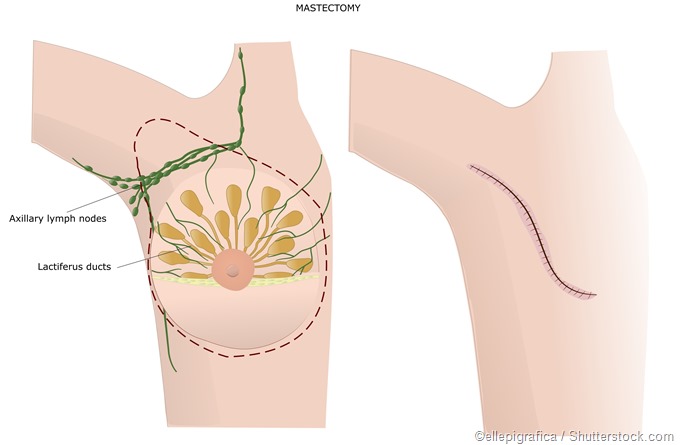 masatectomy illustration